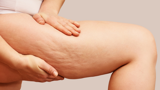 Understanding Cellulite: Causes, Myths, Treatments, and Prevention